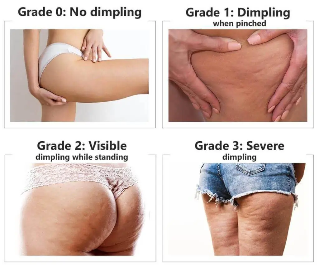 Representation of the stages of cellulite development Uckfield