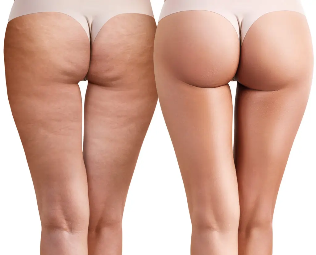 Read about cellulite Uckfield: causes, treatments, and debunked myths